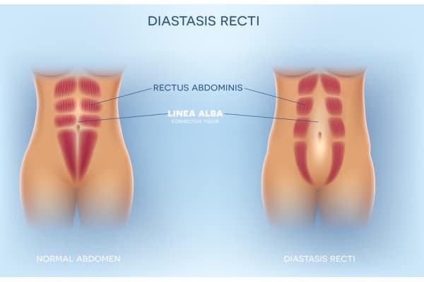 What Non-Surgical Options Are Available for Diastasis Recti Leominster?