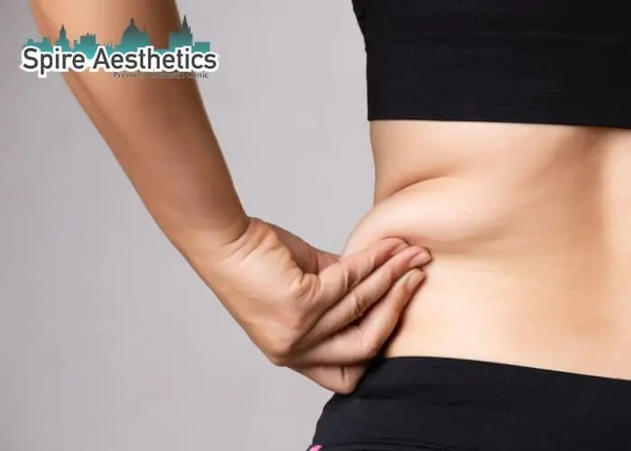 Image of woman pinching fat on their hips Leominster. Fat Freezing treatment