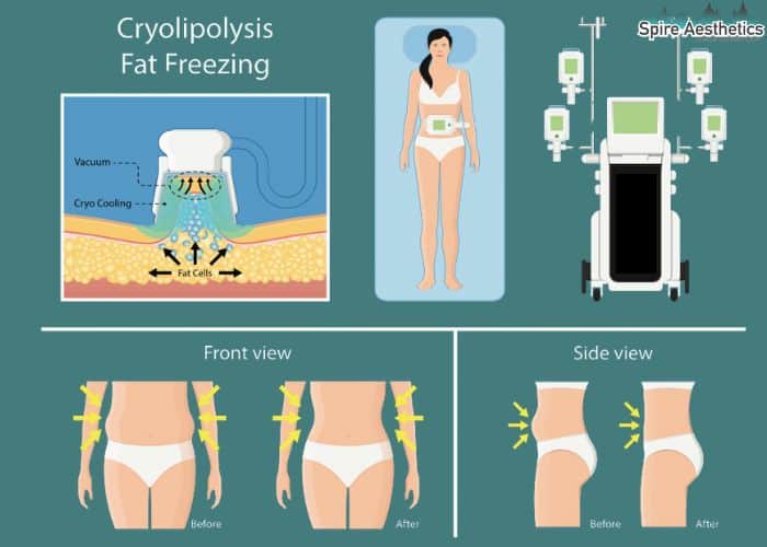 Image of diet and fat freezing combined for best results for Spire Aesthetics Leominster