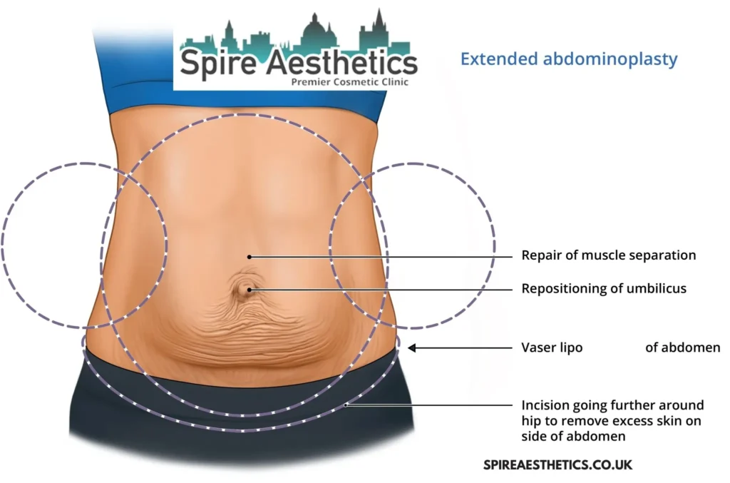 Understanding Loose Skin After Gastric Band Leominster Surgery and HIFU Treatment