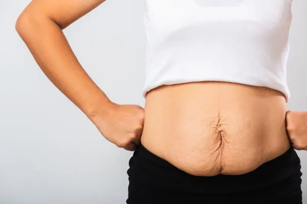 Image of a woman's stomach after weight loss with sagging skin following a gastric band Leominster