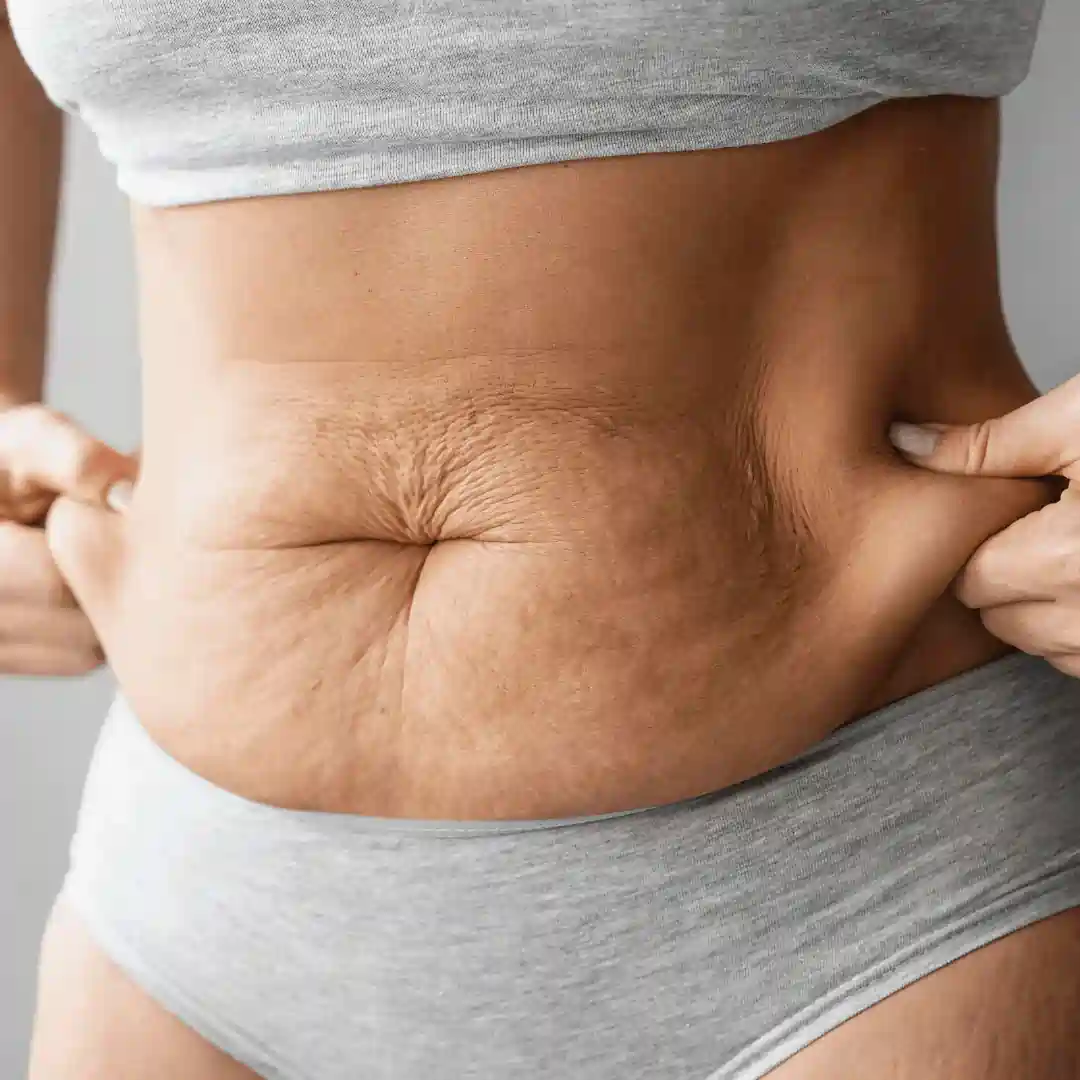 Is It Normal to Have Loose Skin After Pregnancy Leominster?