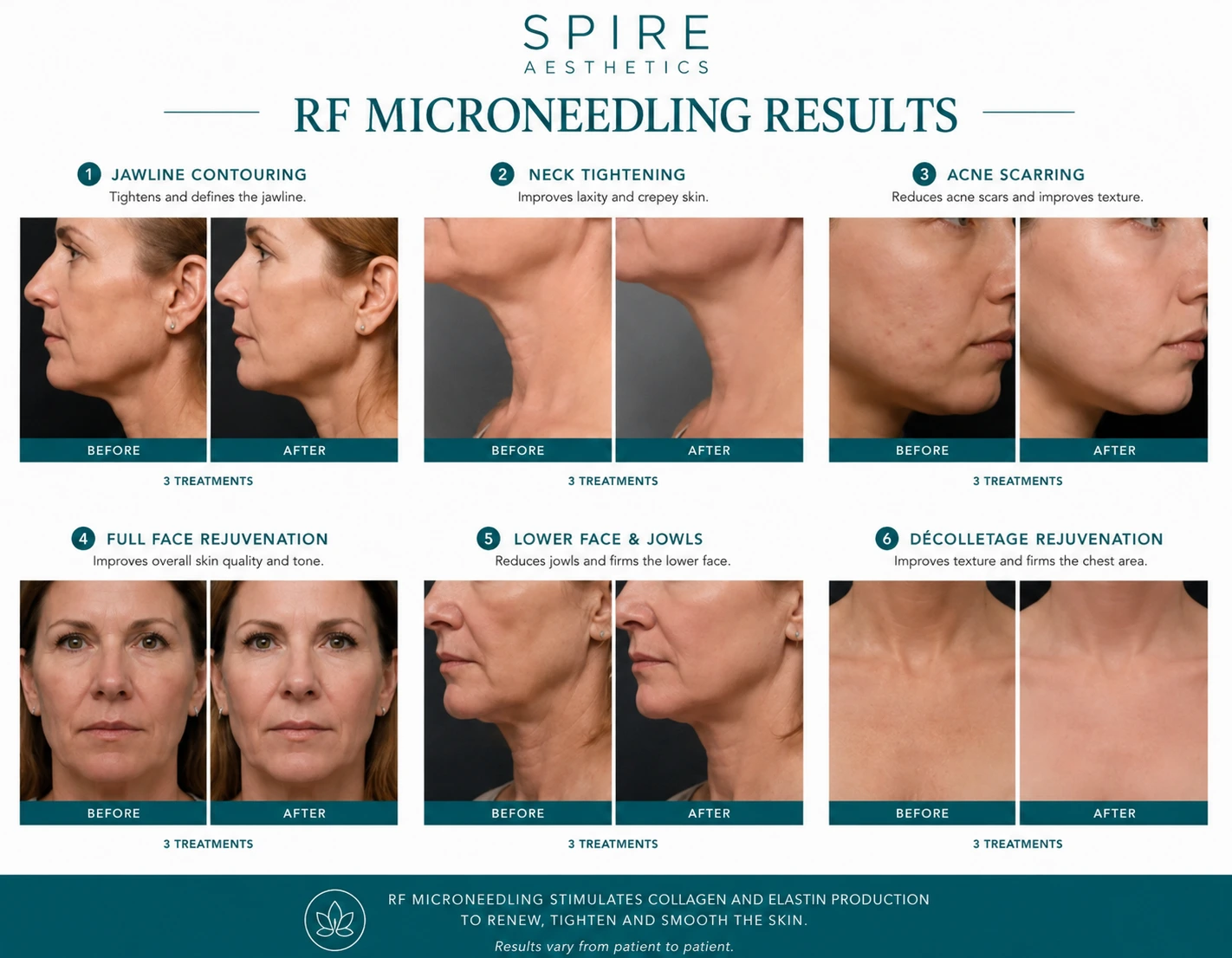 RF Microneedling Skin tightening Leominster results