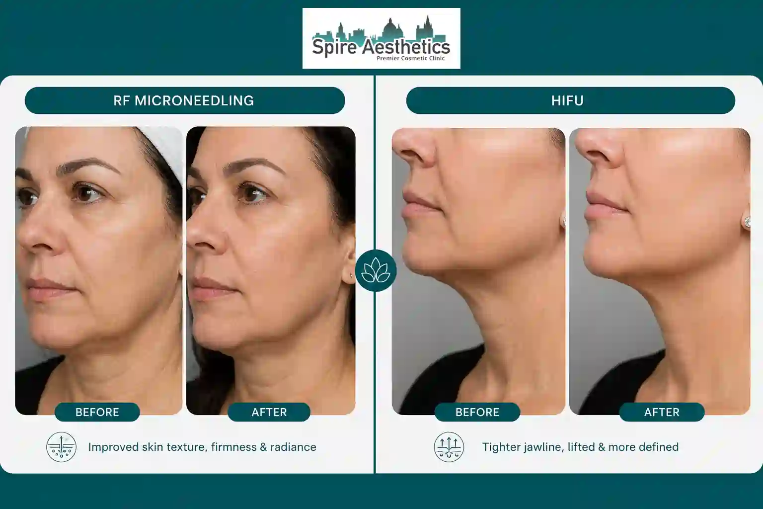 Can RF Microneedling and HIFU Be Combined Leominster?