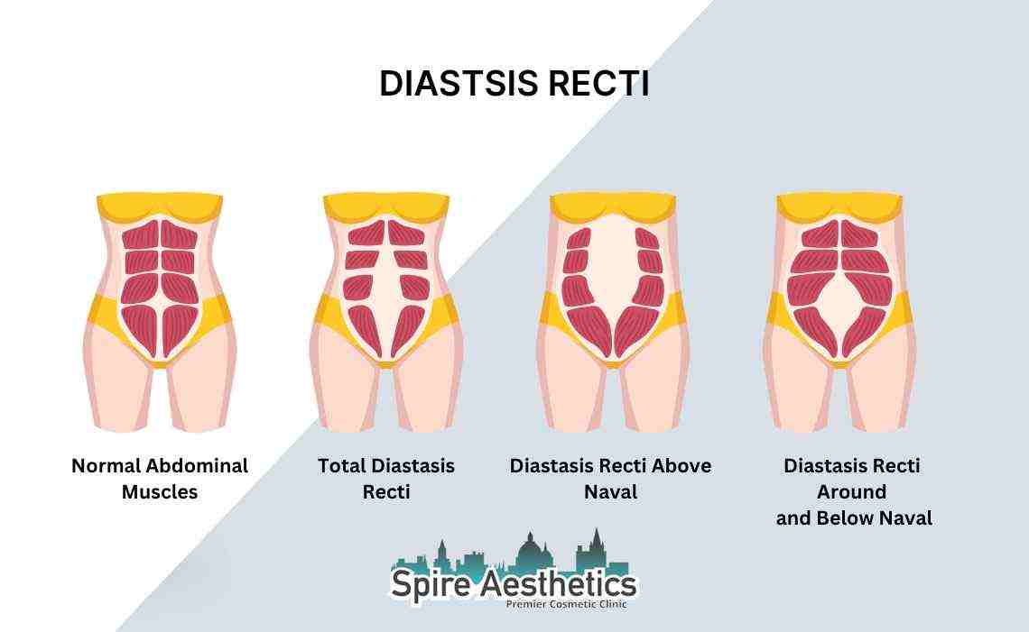 Is Non-Surgical Diastasis Recti Treatment Right for You? Common Concerns Answered Leominster